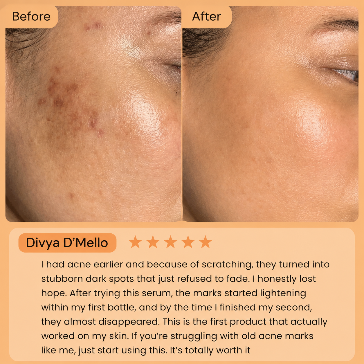 Anua Niacinamide 10% + TXA 4% for Brightening and Dark Spots