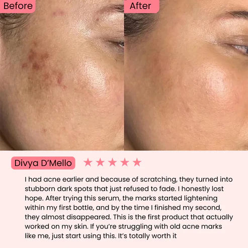 Anua Niacinamide 10% + TXA 4% for Brightening and Dark Spots